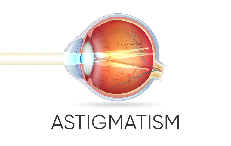 Eye with Astigmatism
