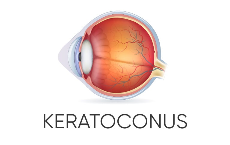 Eye with Keratoconus